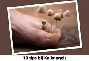 Blog 10 tips bij kalknagels