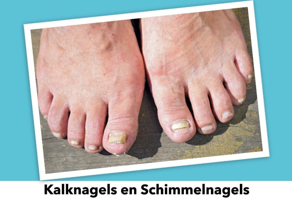 Kalknagel/schimmelnagel: oorzaken, symptomen en behandeling