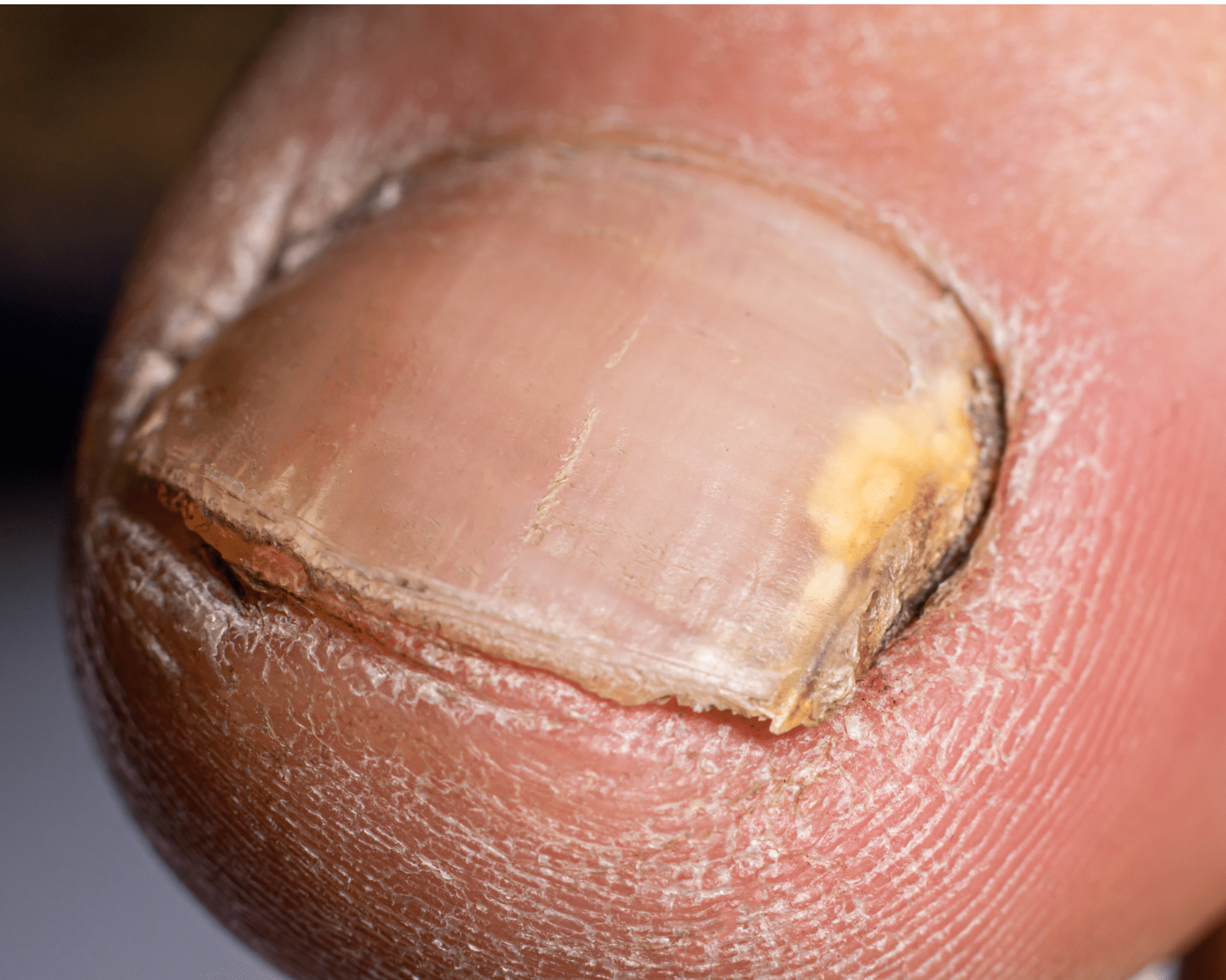 Kalknagel/schimmelnagel oorzaken, symptomen en behandeling