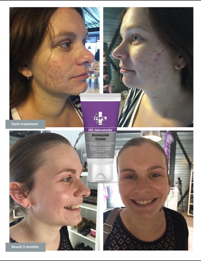 HFL DermaZink werking tegen Acne