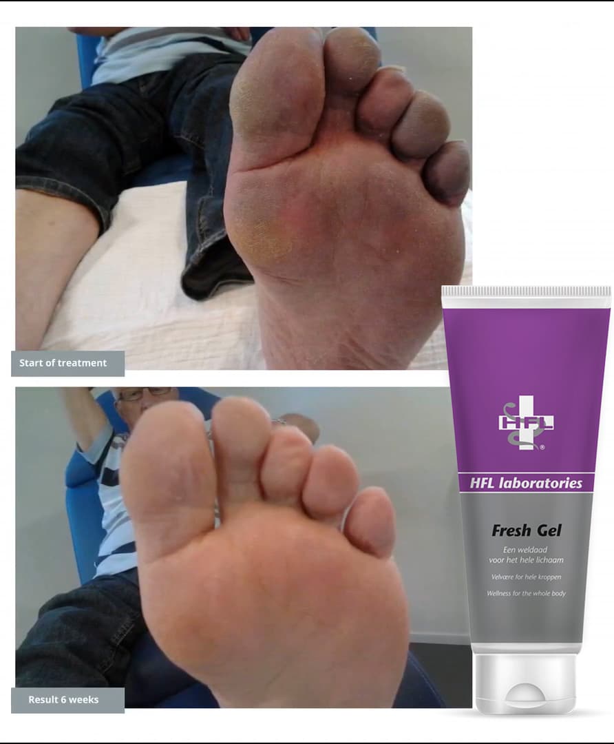 HFL Fresh Gel voor betere doorbloeding en tegen wintertenen