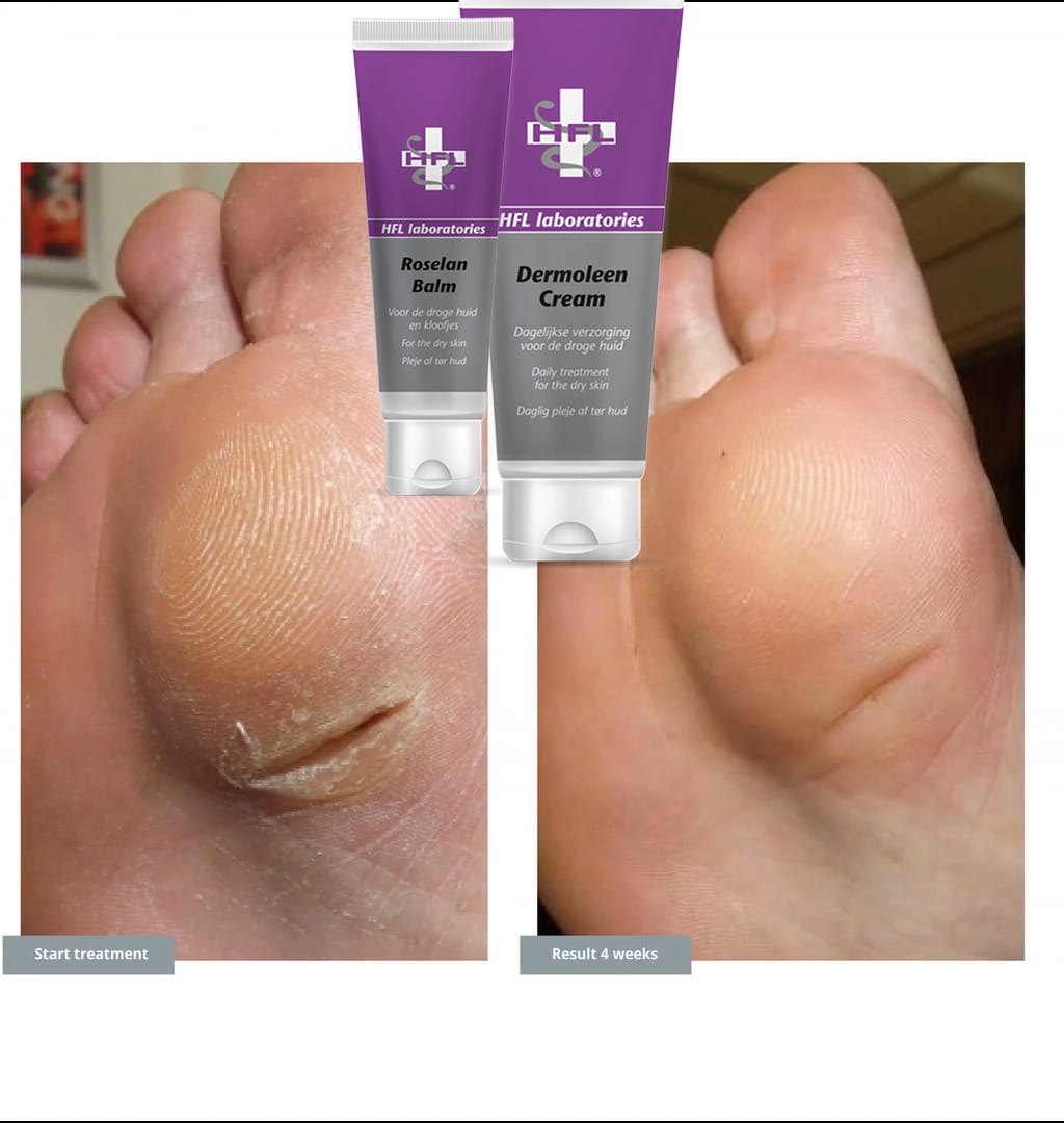 HFL Roselan Balm en HFL Dermoleen Cream werking tegen Kloven en droge huid