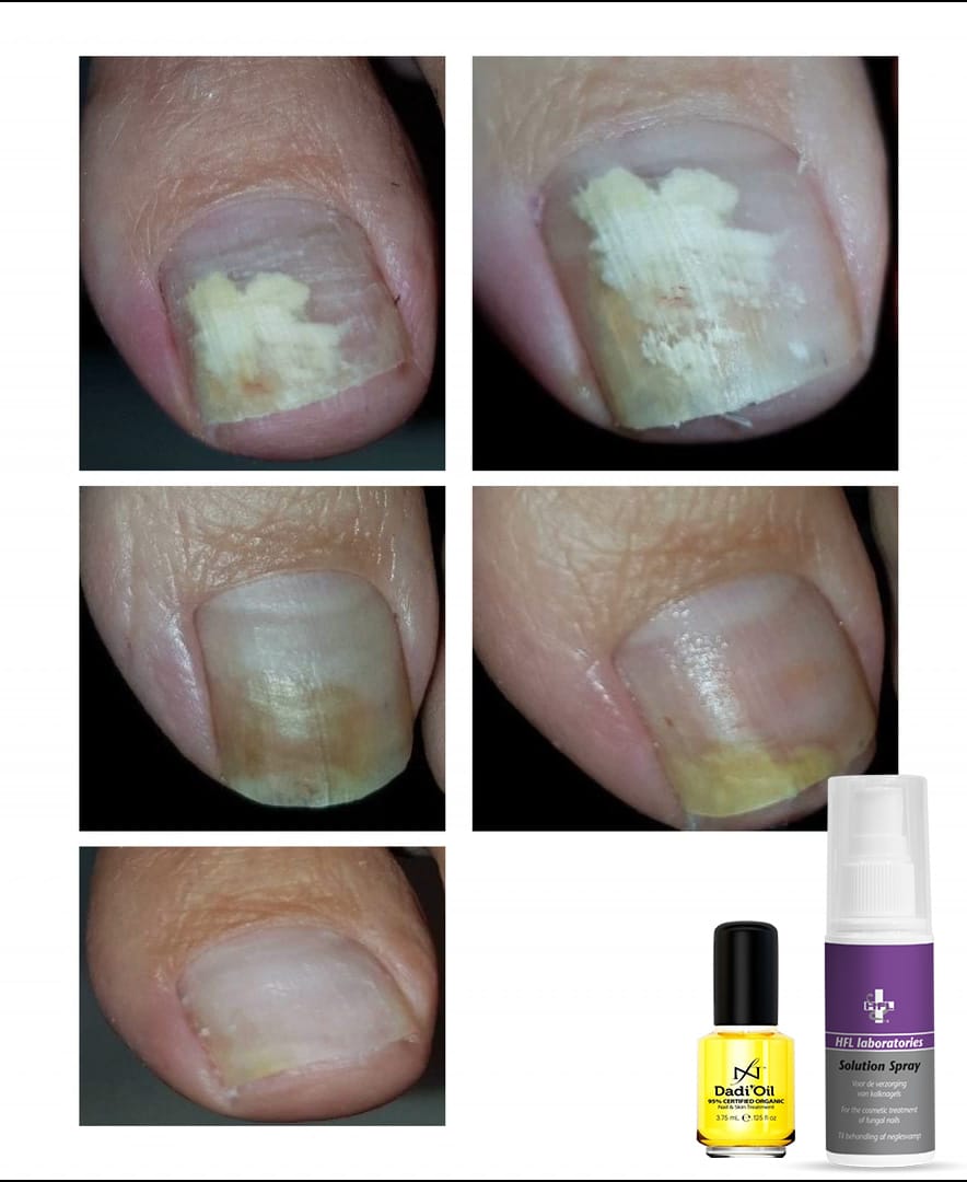 HFL Solution Spray en Dadi Oil tegen Schimmelnagels en Kalknagels