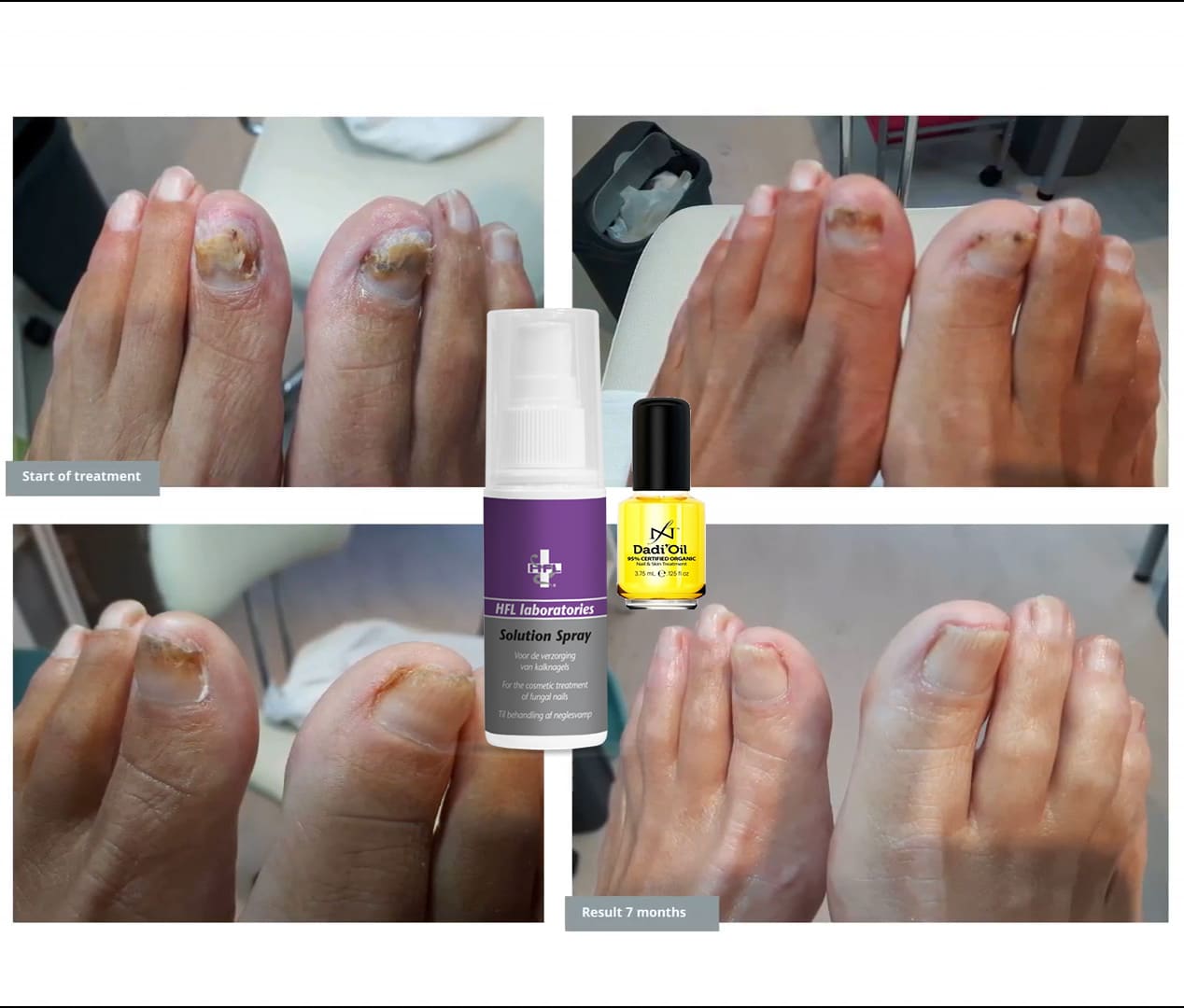 HFL Solution Spray en Dadi Oil voor behandeling van kalknagels en schimmelnagels