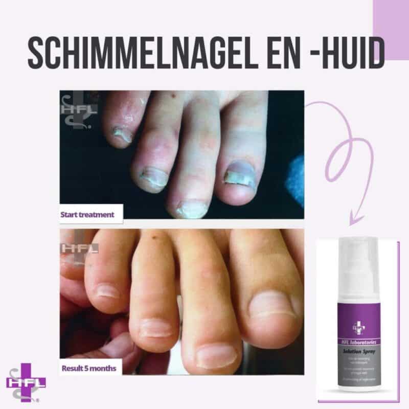 HFL Solution Spray - 5 stuks - Afbeelding 3